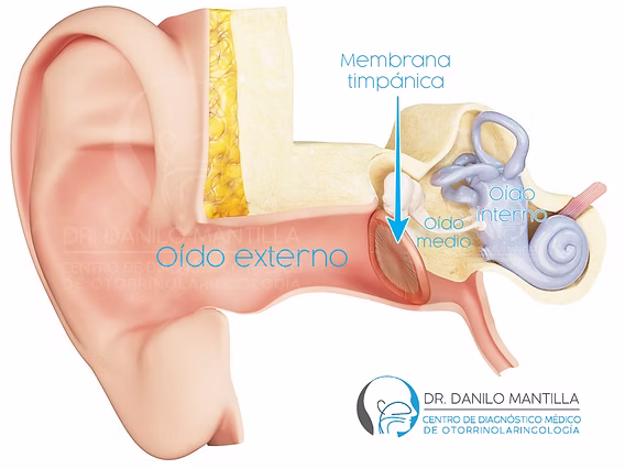 qué significa hipoacusia
