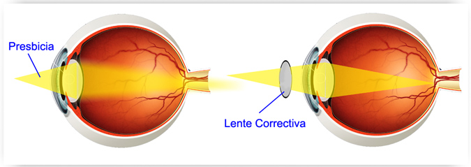 qué significa presbicia
